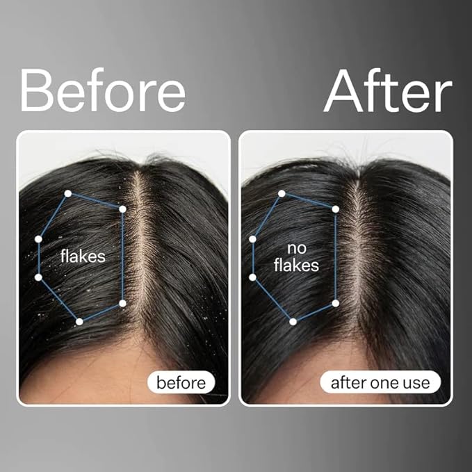 Act+Acre Cold Processed Vitamin E Scalp Detox Oil and BHA Salicylic Acid Exfoliator - For Dandruff and Dry Itchy Scalp - Hair Growth Treatment for Thinning Hair - Exfoliating Mask for Itch