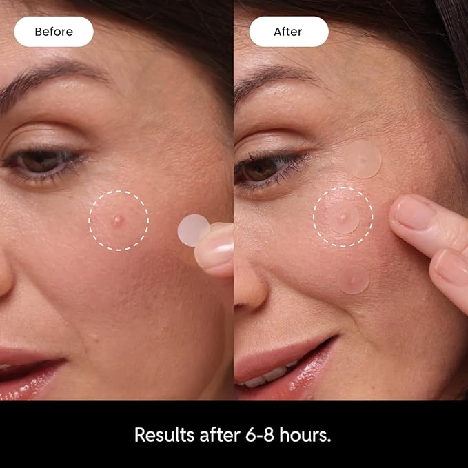 Eliré Daytime Pimple Patch – Ultra-Thin & Invisible Pimple Stickers – Heals & Protects While Blending with Skin – Works Under Makeup, Non-Drying & Dermatologist-Tested