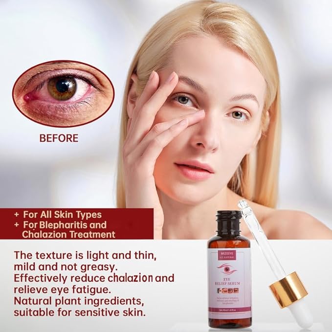 Chalazion Eye Treatment For Blepharitis, 2 PCS Moisturize Eyelids Serum and Chalazion Remover, Gentle Under Eye Relief Serum For Dark Circles, Eye Bags, Puffiness.