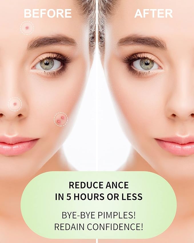 Beviliu 216 Count Pimple Patches for Face(Tea Tree Oil & Ultra-Thin Day/Thick Night Use) Hydrocolloid Acne Patches for Face, Zit Patches for Face, 2 Sizes, Facial Skin Care Products