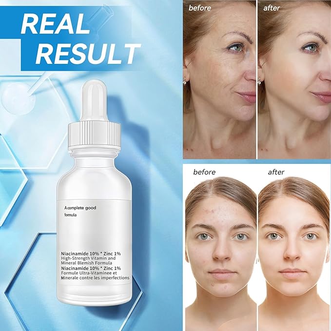 10% Niacinamide + 1% Zinc Face Serum, Nourishing & Refreshing Facial Serum , Women Serum for Oil Control and Acne 30ML/1 Fl Oz