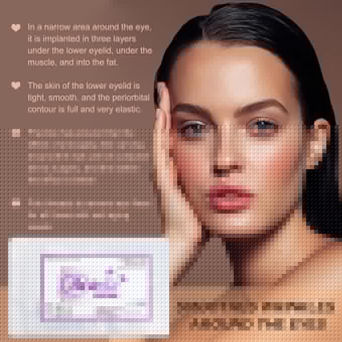 ACADA Pdo Threads for Eye Lift Face Lift Pdo Screw Threads for Eyes lift 30G25mm 40Pcs B-Type, Pdo Periocular Threads, Pdo Threads Eyes