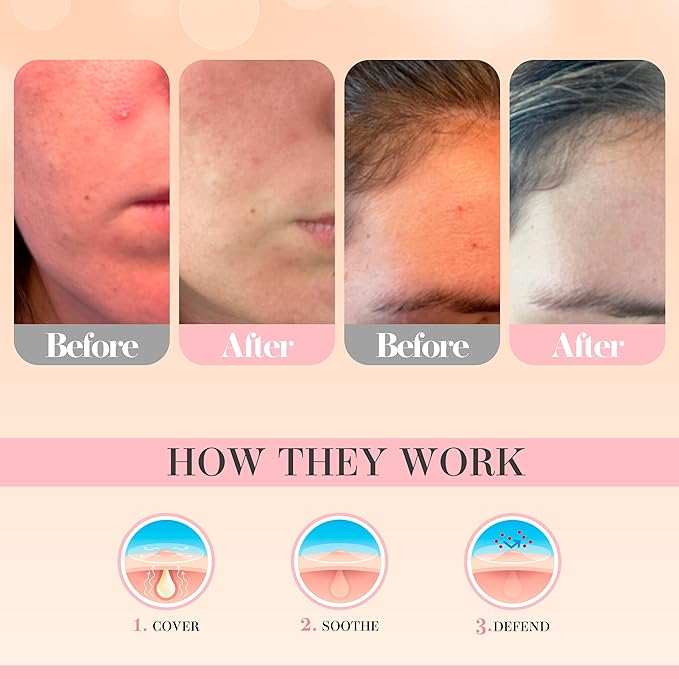 Glacia Pimple Patches 72 Pack of Hydrocolloid Skin Patches for All Skin Types β Gentle and Natural Patches for Clear and Smooth Skin