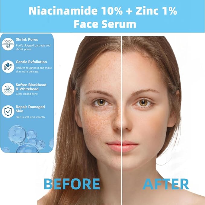 10% Niacinamide + 1% Zinc Face Serum, Nourishing & Refreshing Facial Serum , Women Serum for Oil Control and Acne 30ML/1 Fl Oz