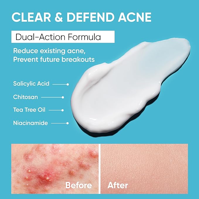Butt Acne Clearing Treatment Cream: Clears & Prevents Breakouts Fast – Gentle Body & Back Lotion for Clogged Pores, Folliculitis & Bumps, 2% Salicylic Acid & Niacinamide, Ideal for Women, Men & Teens