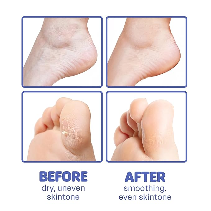 ONSOI 12PK Foot Masks for Soft, Smooth, Moisturizing Foot Mask for Dry Cracked Feet, Baby Feet - Coconut & Shea Butter (12PK Coconut)