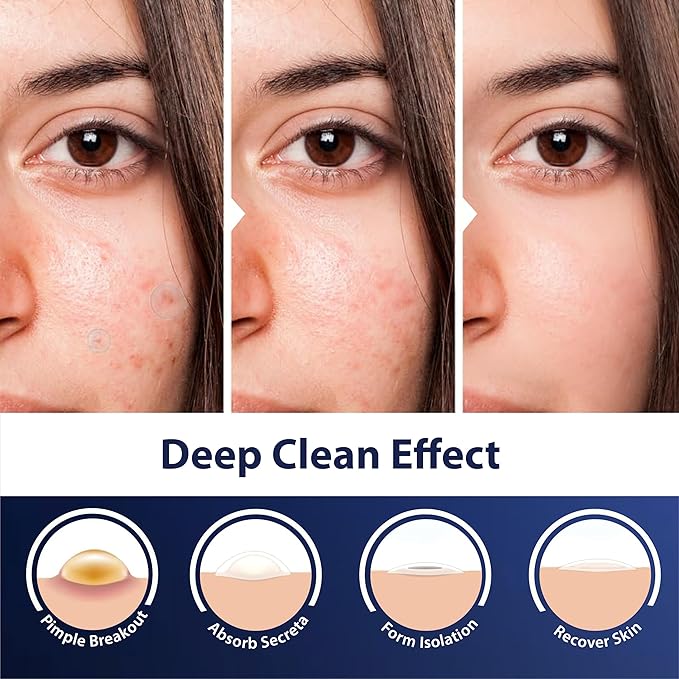 Dot Pimple Patches for Face β Hydrocolloid Acne Patches for Quick Zit Relief And Blemishes, Invisible Spot Stickers That Stay All Night, Gentle for All Skin Types, Oil-Free (40 Count)