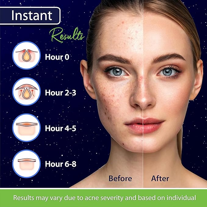 Dot Pimple Patches for Face β Hydrocolloid Acne Patches for Quick Zit Relief, Invisible Spot Stickers That Stay All Night, Gentle for All Skin Types, Oil-Free (240 Count)