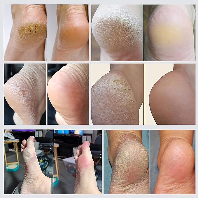 Made in Germany Double-Sided Metal and Emery Foot File - Heel Scraper & Cracked Feet Repair Instant Exfoliating Peel Foot Spray - Dead Skin Remover Cracked Heels Softener. Wonder Pedi