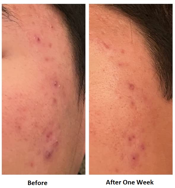 Acne Treatment For Sensitive Skin - 80% of Acne Gone in 4 Weeks. Pimple Cream Stops Face Acne and Teen Acne Without Drying or Irritating Skin. Zit Cream, Face Toner for Pimple Prone Skin.