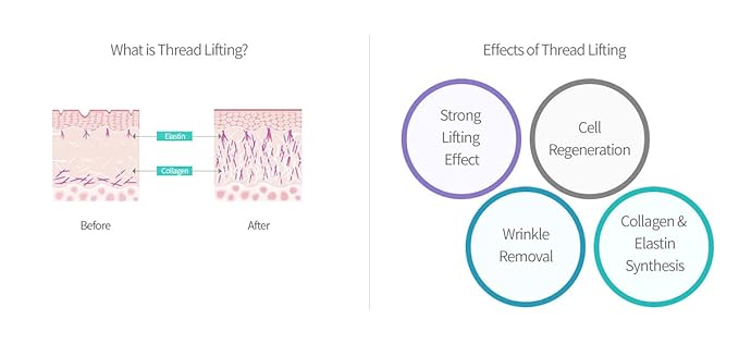 NeoGenesis PDO Mono Threads for Face and Body Lift 20PCS (31G X 12mm) (M3112)