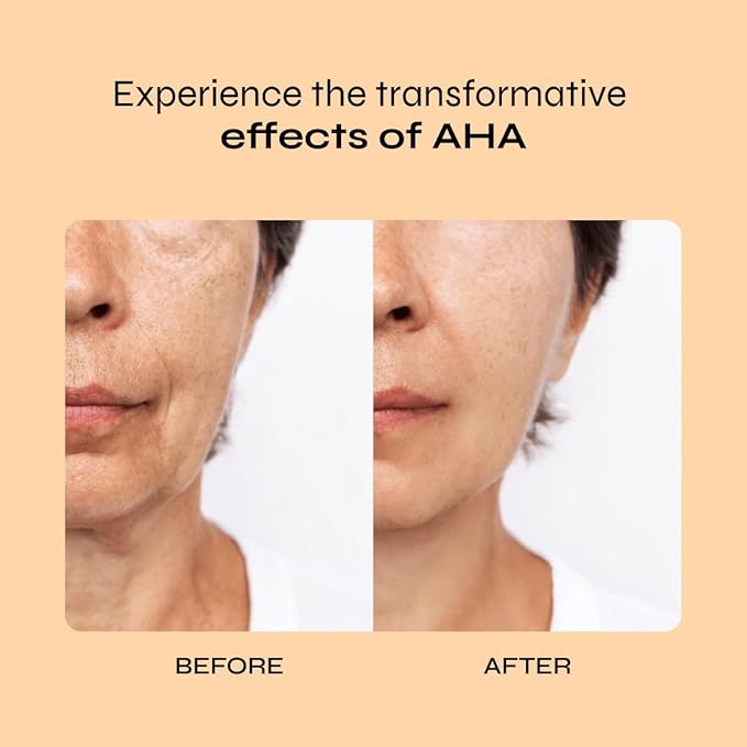 A-Cute Derm Ultra 10 AHA Anti-Aging Lotion for Exfoliation Simple and Effective for Face and Body (4 OZ)