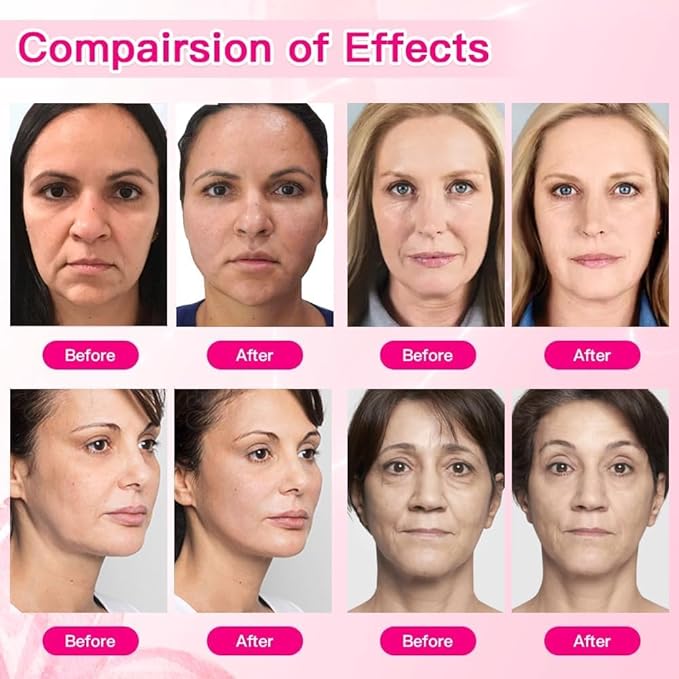 Pdo Thread For Face Lift/Whole Body Lift 360R Cog Thread/Cog Threads Face Lift (Mono 26G 60mm 20pcs)