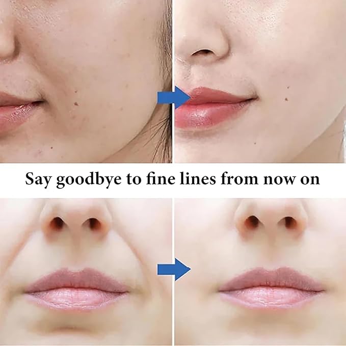 Microcrystalline Nasolabial Folds Removal Mask, Hyaluronic Acid Microcrystalline Lifting Decree Patch, Face Wrinkle Removal Mask, Microcrystalline Lifting Mask, for Reduce Fine Lines(2 boxes/10 pairs)