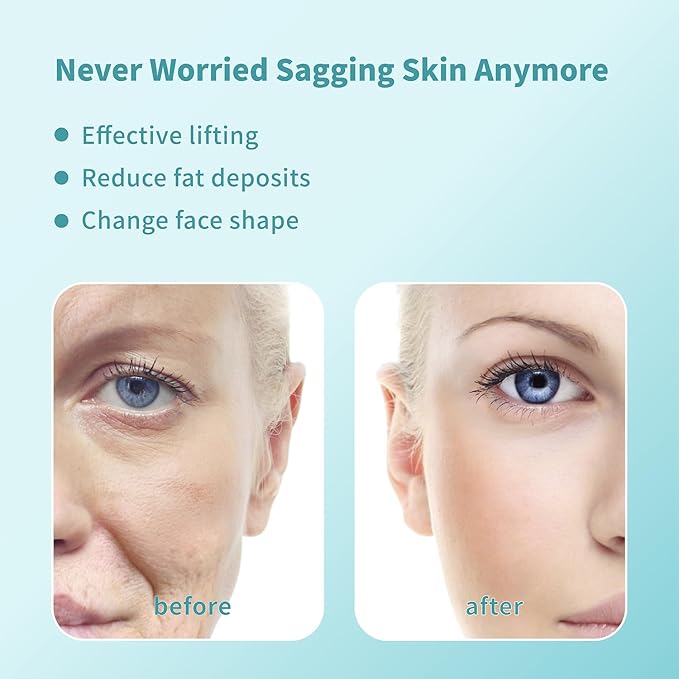 Pdo Threads Pdo Threads Lift for Face Smoothing Wrinkles Pdo Screw Threads Producs Collagen Pdo Lifting Threads Skin Tighten 30g38mm 40Pcs