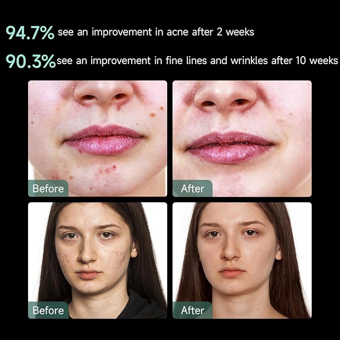 Aphrona® | FDA cleared Moonlight LED Facial Mask Skin Care Mask, LED Light Therapy Red Blue light for Acne Removal Wrinkle Reduction