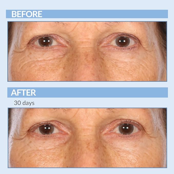 Serious Skincare - Retinol Vitamin A Eye XR Under Eye Cream Concentrate - Reduce Fine Lines, Dark Circles & Puffiness - Daily Wrinkle Cream - Anti-Aging - 0.5 oz