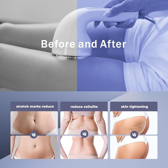 Radio Frequency Induced Heat-Palm NRG Cellulite Body Device