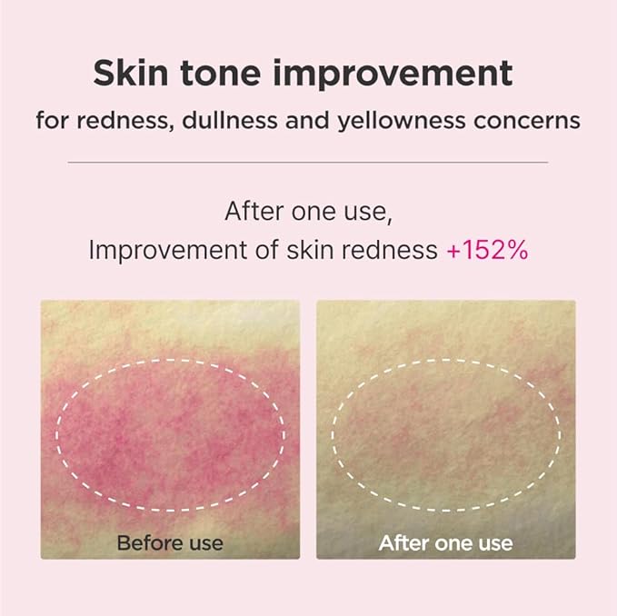 ISOI Blemish Care Up Serum Special Kit, 5-Step Korean Skin Care Set for Hydration & Radiance, Travel Size Gift Set (Serum, Tonic Essence, Cream, Pad, Mask)