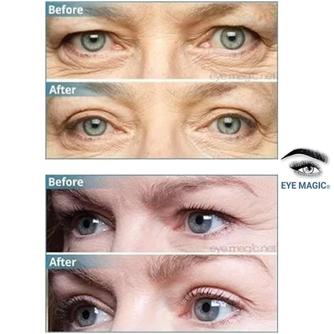 Original Eye Lift Kit (Small/Medium Size With Gel) Lifts Eyelid Droop and Hooded Eyes | Open And Show Off Your Beautiful Eyes | Made In America