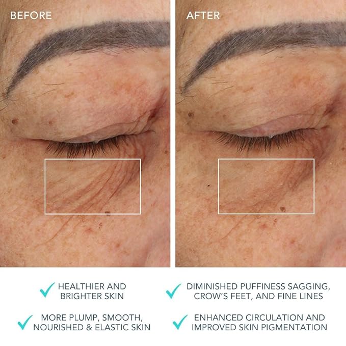 ACADA Pdo Threads for Eye Lift Face Lift Pdo Screw Threads for Eyes lift 30G25mm 40Pcs B-Type, Pdo Periocular Threads, Pdo Threads Eyes