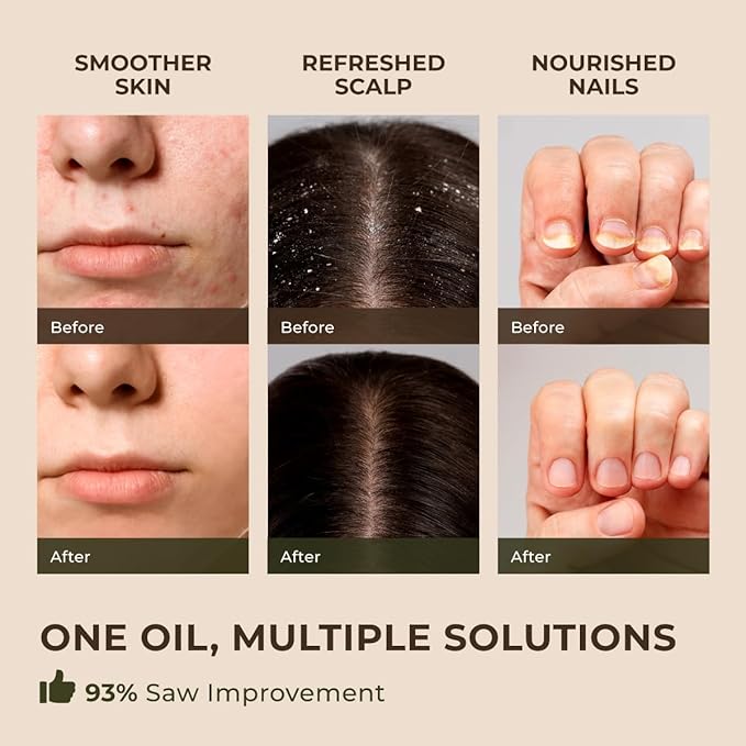 Gya Labs Australian Tea Tree Essential Oil for Skin - 0.34 Fl Oz - 100% Pure Natural Melaleuca Tea Tree Oil for Hair, Face, & Toenail, Piercings Scalp & Candle Making Scent