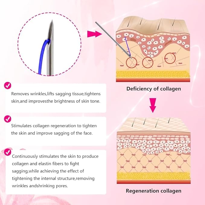 Pdo Thread For Face Lift/Whole Body Lift 360R Cog Thread/Cog Threads Face Lift (Mono 26G 60mm 20pcs)