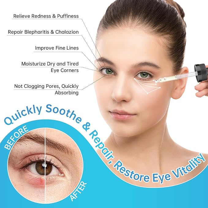 Eye Serum For Chalazion & Blepharitis Treatment, 2 PCS Chalazion Remover For Eyelid Treatment, Eyelid Serum With Avocado Oil, Sea Buckthorn Oil & Caffeine, Relieve Puffiness and Eye Fatigue