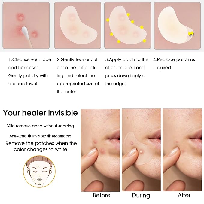 Hydrocolloid Acne Patch(20 Patches), Large Spot Control Cover With Long Size, Extra Larger Acne Pimple Patch for Covering Large Breakouts, Spot Patch, Stickers for Body, Cheek, Forehead, and Chin