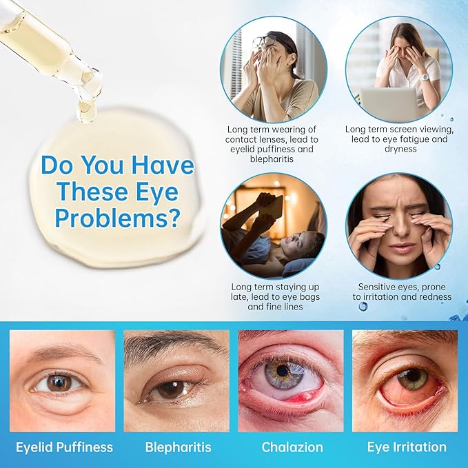 Eye Serum For Chalazion & Blepharitis Treatment, 2 PCS Chalazion Remover For Eyelid Treatment, Eyelid Serum With Avocado Oil, Sea Buckthorn Oil & Caffeine, Relieve Puffiness and Eye Fatigue