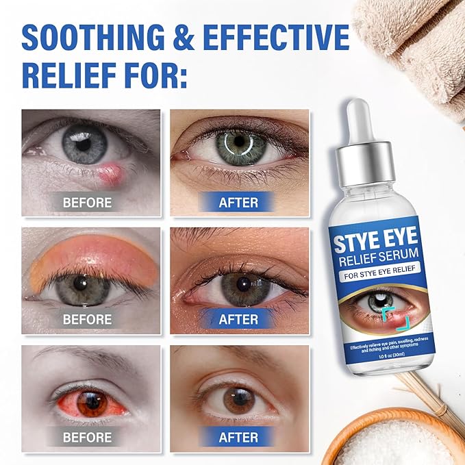 ITECFREELY Stye Eye Treatment, Natural Stye Eye Relief Drops Serum for Styes Chalazion and Blepharitis, Fast Chalazion Remover for Restore Healthier Skin-1 Fl.oz