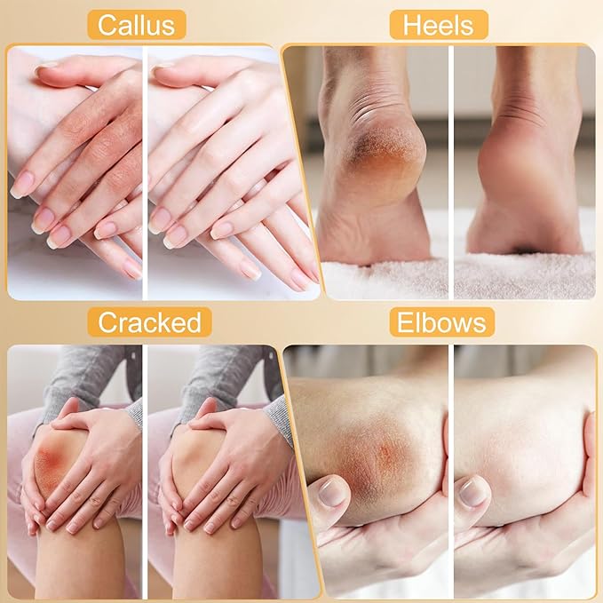 Urea Cream 40%，Urea Cream 42% Plus 2% Salicylic Acid Maximum Strength For Feet,Foot Cream for Dry Cracked Heels Feet Knees Elbows Hand，Travel and Home Foot Care Kit，Foot Heel，Gift Pack