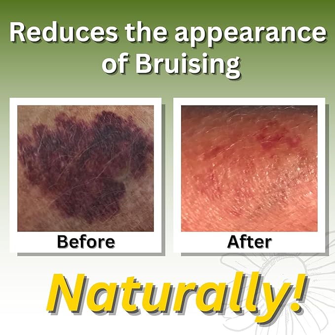 Relief Arnica Cream – Enriched with Lemongrass, Eucalyptus & Rosemary Essential Oils – All Natural Massage Lotion for Sore Muscles & Stiffness. Perfect for Massage Therapy by Brookethorne Naturals