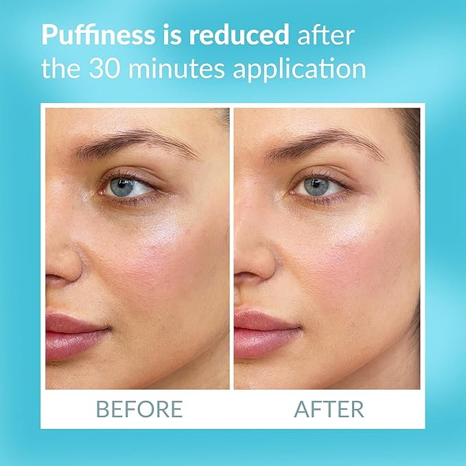 Talika Eye Therapy Patch - Instant Smoothing Patches - Mask For Dark Circles Puffiness & Tired Eyes - 6 Refills Reusable Under Eye Patches for Adults Skincare Eye Treatment