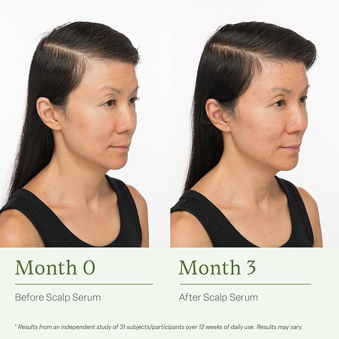 Divi Scalp Serum for Thinning Hair, 15ml – Clinically Tested, Nourishing Formula with Amino Acids, Caffeine & Rosemary Oil – Promotes Healthy Scalp & Fuller-Looking Hair, Reduces Oil & Product Buildup