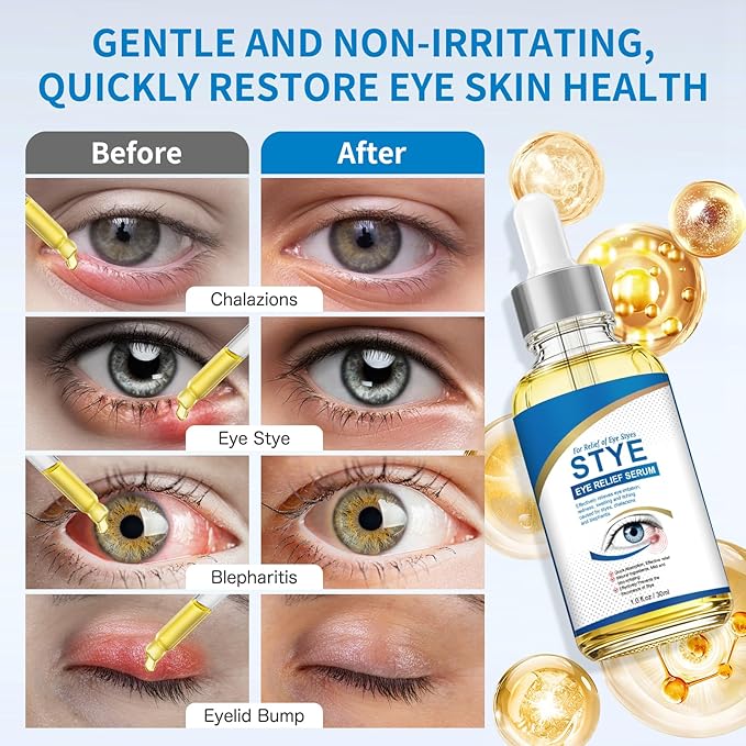 Stye Eye Treatment, Natural Stye Relief Serum for Styes, Chalazions and Blepharitis, Quickly Relieves Eye Irritation and Restores Healthier Skin